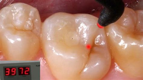 Diagnodent Diagnóstico De Caries Por Láser