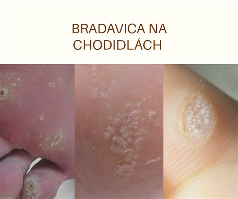 Bradavica Na Chodidl Ch Pedante