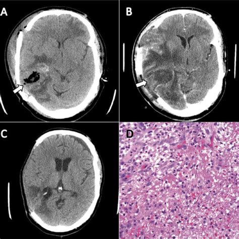 Cases Of Adult Mycoplasma Hominis Brain Abscess Download Table