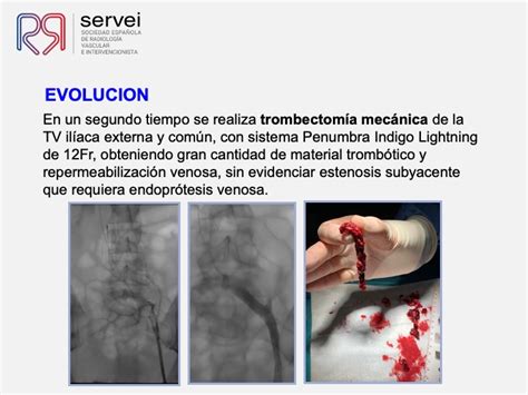 Fibrinolisis con catéter para el TEP Caso clínico SERVEI