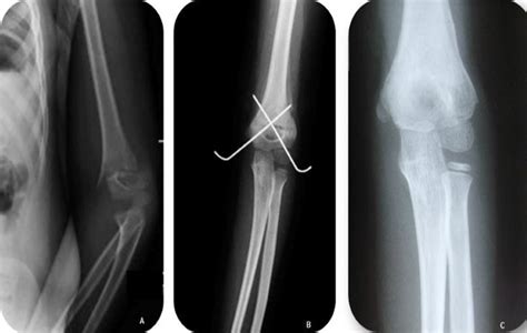 A Pre Opx Ray B Immediate Post Op X Ray Showing Cross Pin Construct