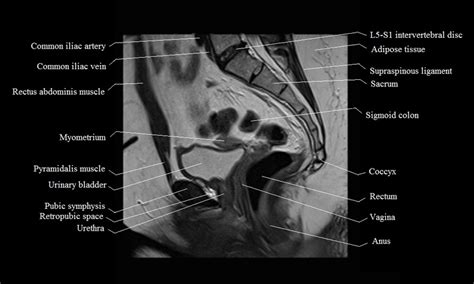 Mri Female Pelvis Anatomy Free Mri Sagittal Cross Sectional Anatomy