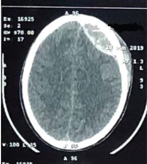 Resolution Of Asymptomatic Significant Volume Extradural Haematoma On