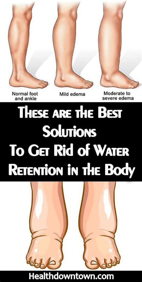 Causes Of Water Retention In Legs And Feet