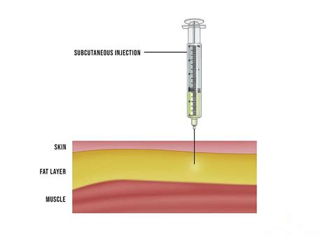 Subcutaneous Injection Photograph by Maurizio De Angelis/science Photo Library