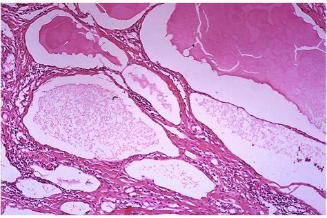 Lymphangioma Histology