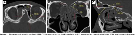 Figure 1 From The Supraethmoidal Roof Cell An Unreported Sinus