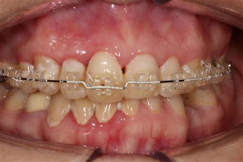 Introduction In To Wire Bending To Finish Orthodontic Cases Dr Gurs Sehmi