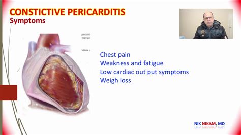 Constrictive Pericarditis What To Know