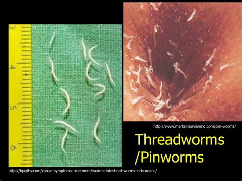 Pin Worms Pin Worms In Poop Polfbat