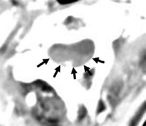 Figure 1 From A Spinal Epidural Hematoma With Symptoms Mimicking