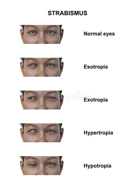 A Woman with Various Strabismus Types, 3D Illustration Stock ...