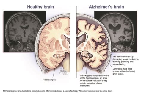 HOW ALZHEIMER’S AFFECTS THE BRAIN | Sensations Memory Care Residence