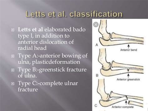 Management of neglected monteggia fracture