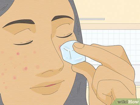 3 Ways to Get Rid of a Popped Pimple Overnight - wikiHow