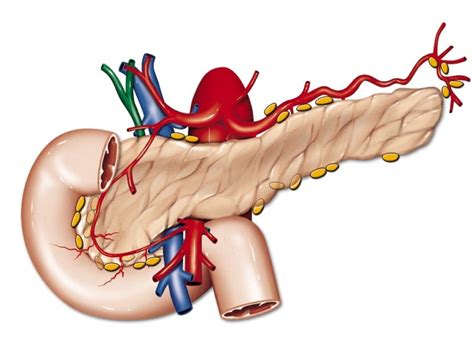 Tumori Del Pancreas