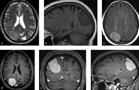 Meningioma Classification Expert Surgeon Aaron Cohen Gadol Md