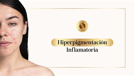 Hiperpigmentación Inflamatoria Dra Natalia