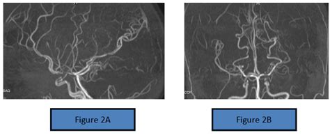 Figure 2A And 2B Magnetic Resonance Angiography MRA Revealed