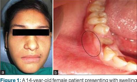 Figure 1 From Adenomatoid Odontogenic Tumor An Unusual Presentation