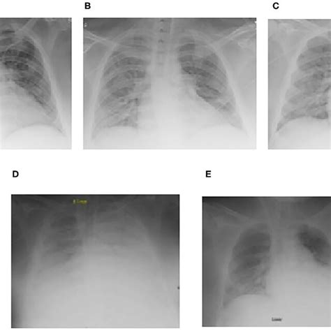 Serial Chest Radiographs For Case 1 Demonstrating The Progression And