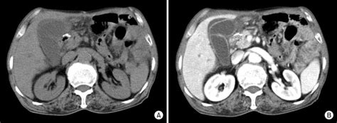 Axial Unenhanced A And Contrast Enhanced Abdominal Computed