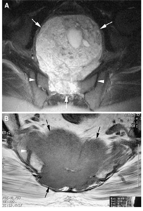 Ab A An Axial Fat Suppressed T2 Weighted Fast Spin Echo Mr Image