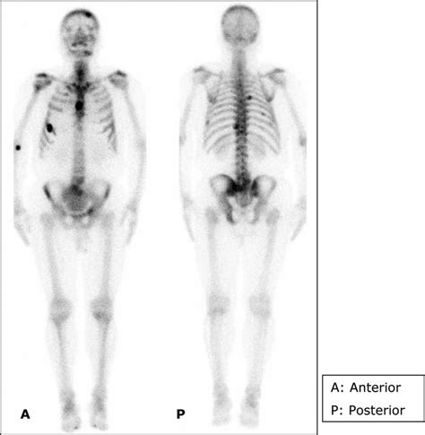 The Anterior And Posterior Whole Body Bone Scans Indicate Increased