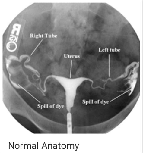 Hysterosalpingography Hsg Or Uterosalpingography