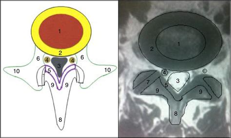 SciELO Brasil Accuracy Of The Kissing Sign On Lumbar Spine MRI In