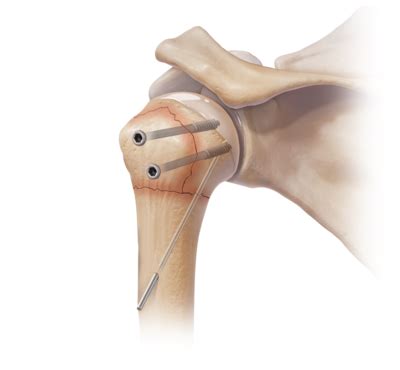 Arthrex Humeral Fracture Implants