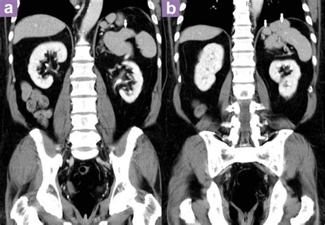 Accessory Spleen Prevalence And Multidetector Ct Appearance