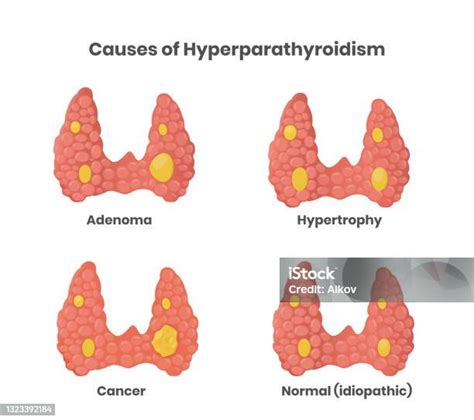 Hyperparathyroidism Causes Illustration Adenoma Cancer Enlargement And