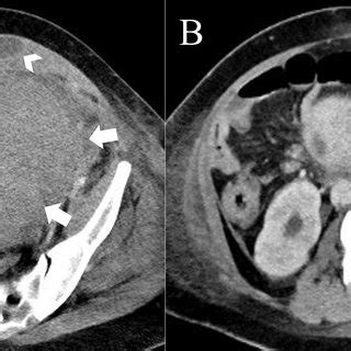 Computed Tomography Angiogram Taken On Day Of Admission A White