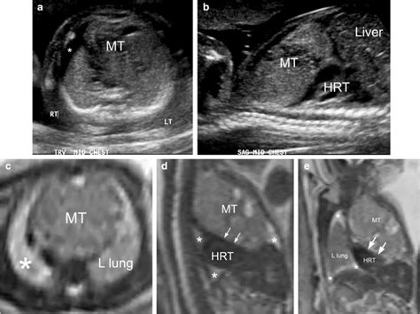 A 26-week fetus with mediastinal teratoma. a A transverse gray-scale ...