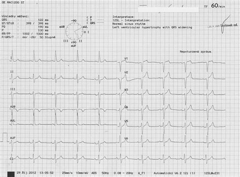 Ekg Z Praxe Medic Na Nemoci Studium Na Lf Uk