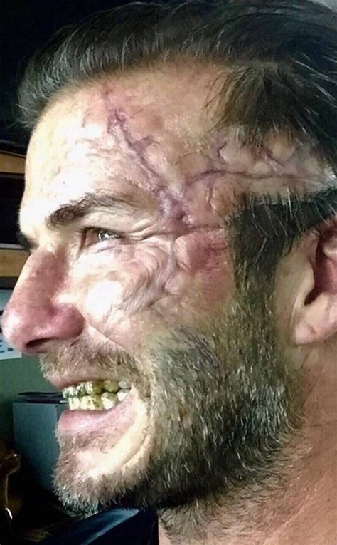 David Beckham Choca Seguidores Ao Aparecer Cicatrizes E Dentes