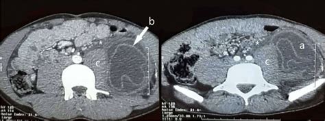 Computed Tomography Scan Image Showing Hydatid Cyst A With Detached