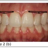 Patient With Bilateral Agenesis Of The Maxillary Lateral Incisors