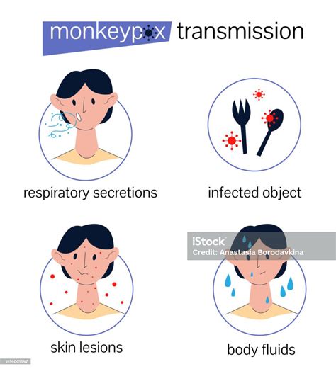 Transmission Of Monkeypox Stock Illustration - Download Image Now ...