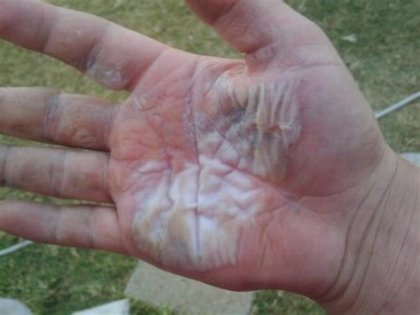 Effects Of Derma Gel On A Third Degree Burn Of The Hand