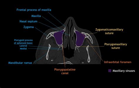 Ct Axial Face Anatomy Casestacks