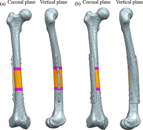 fixation device design  plate fixation  integrated fixation