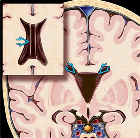 Cavum Septum Pellucidum Diagram