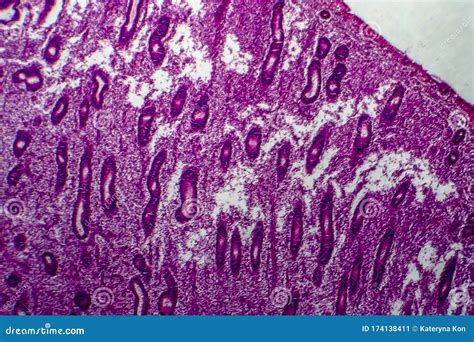 Endometrial Hyperplasia Light Micrograph Stock Image Image Of