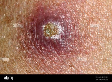 Cutaneous Leishmaniasis Skin Infection On A Patients Arm Close Up This Condition Is Caused By