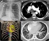 Scielo Brasil Unilateral Proximal Interruption Of A Pulmonary