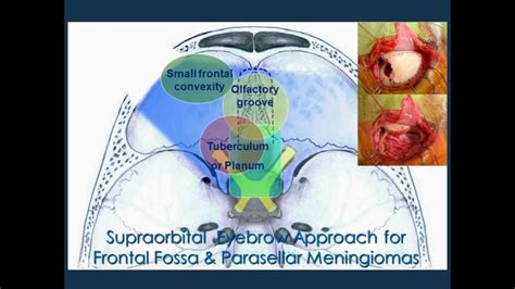 Meningioma Minimally Invasive Keyhole And Endoscopic Surgery Updated