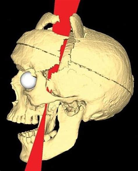 Phineas Gage Psychology And Traumatic Brain Injury Hubpages