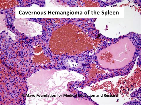 Splenic Hemangioma Mayo Clinic Proceedings